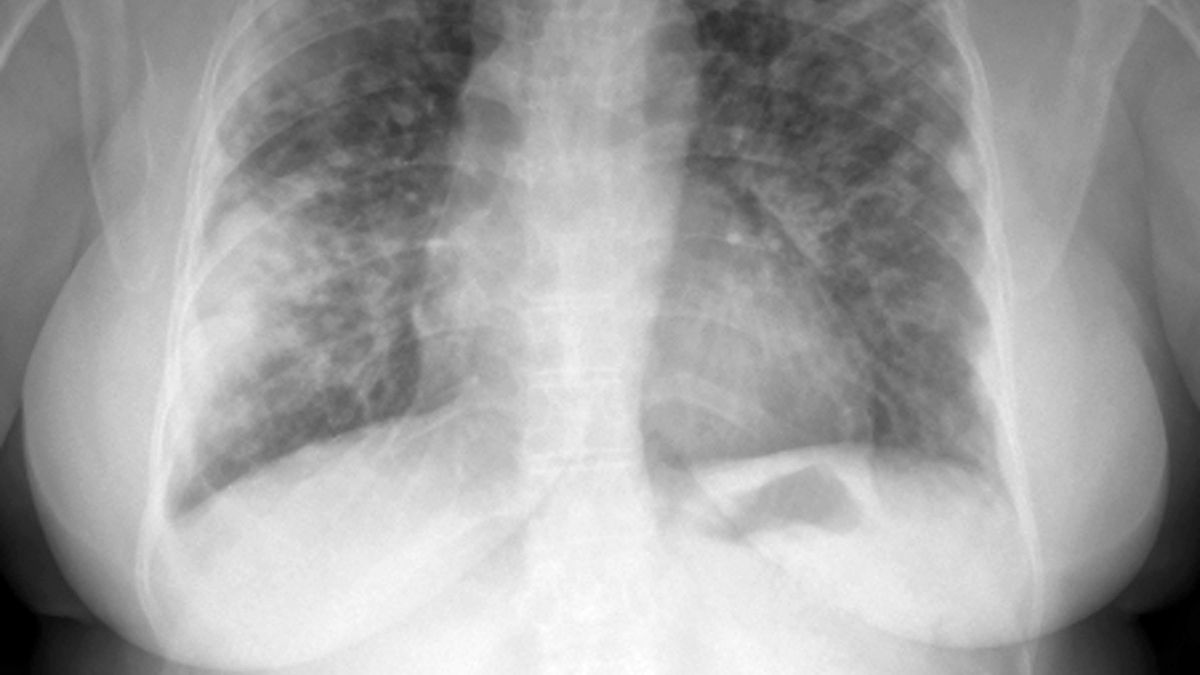 Případů tuberkulózy v Česku výrazně přibylo